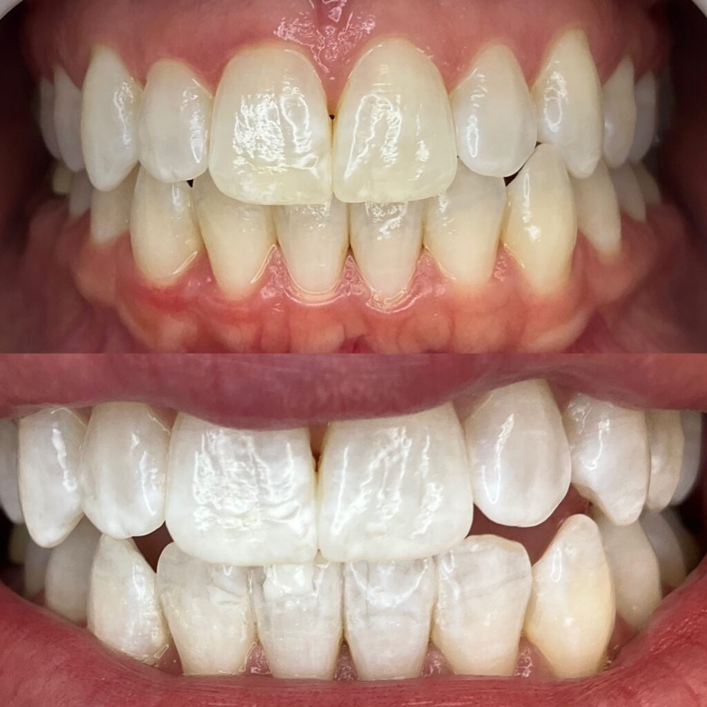 up close image of teeth before and after teeth whiting, brand partner of Inclusive Natural Medicine.